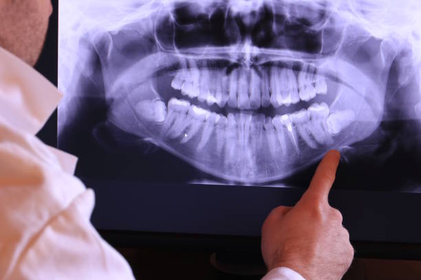 Best Knocked-Out Tooth (Avulsed Tooth) Treatment in Mckinney, TX
