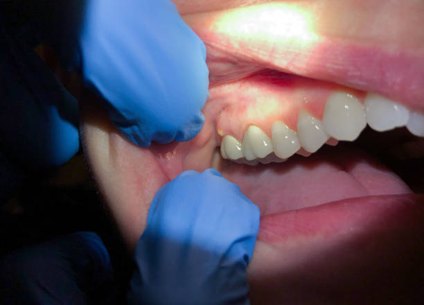 Best Dental Abscess Treatment in Mckinney, TX