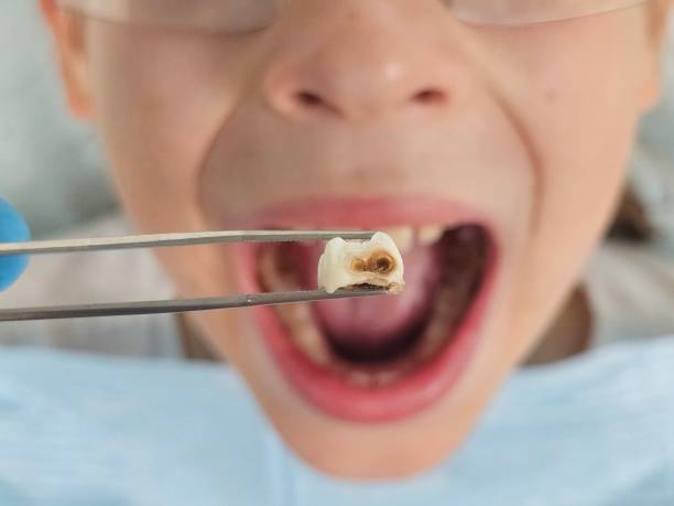 Best Emergency Dental Care for Sports Injuries in Mckinney, TX